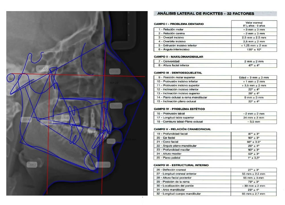 CEFALOMETRÍA DE RICKETTS -LATERAL- Y DIAGNÓSTICO CEFALOMÉTRICO COMPUTARIZADO - Dr. Roberto Ruiz y Dra. Marta Susana Rua.